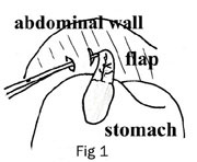 Belt-Loop Gastropexy