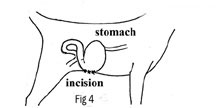 Incisional Gastropexy